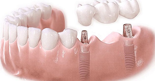 Đến trung tâm lớn để có kỹ thuật trồng răng Implant tốt hơn
