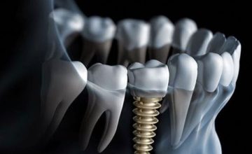 Thực hiện trồng răng Implant ở đâu an toàn nhất