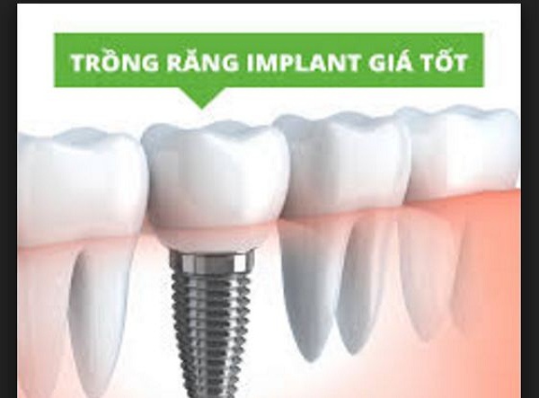 Thực hiện trồng răng Implant giá bao nhiêu là tốt?