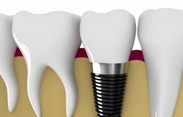 Trồng răng Implant ở đâu tốt nhất